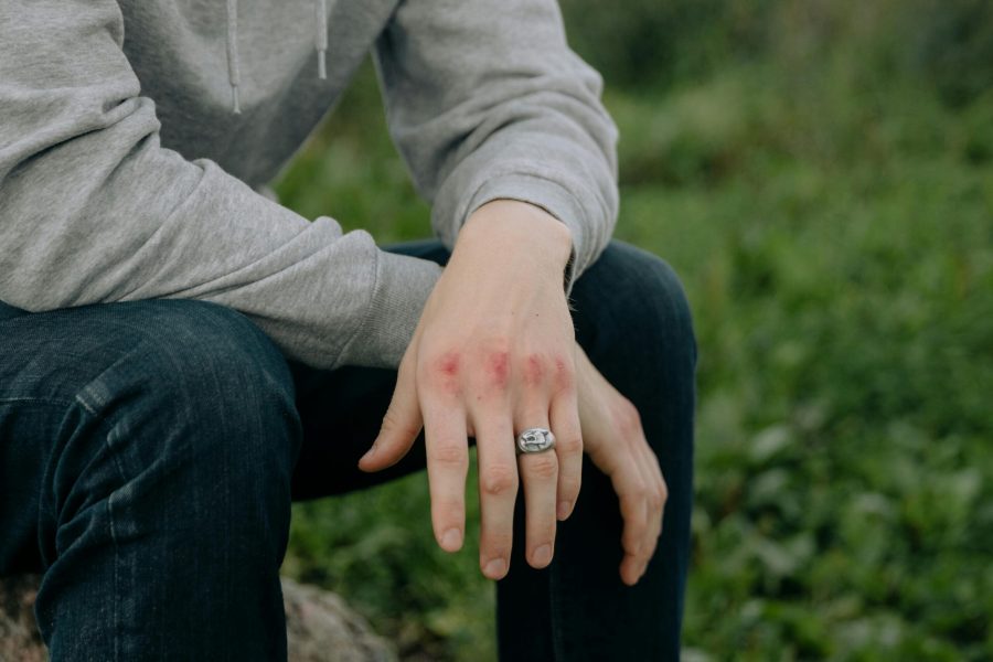 pexels photo 7243776 7243776 A close-up of a person's bruised hands with a ring, wearing casual attire in an outdoor setting.